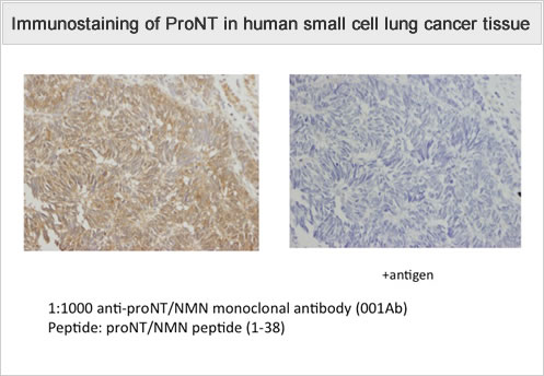 Immunostaining of ProNT in human small cell lung cancer tissue